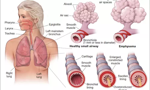 വായുവിലൂടെ പകരുന്ന ശ്വാസകോശ രോഗങ്ങൾ 
