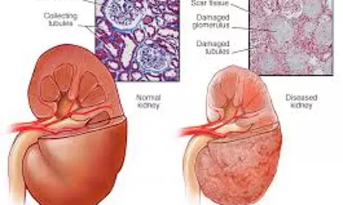 വൃക്കരോഗം : ഈ ലക്ഷണങ്ങൾ അവഗണിക്കരുതേ 