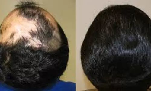 കഷണ്ടിയും മുടിമാറ്റിവെക്കലും