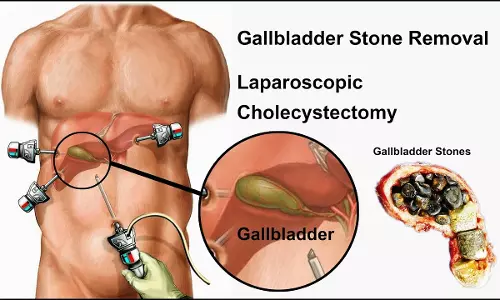പിത്ത സഞ്ചിയിലെ കല്ല് | Stone In Gall Blader 