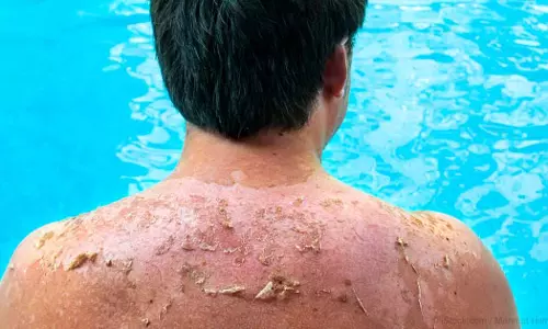 സൂര്യതാപം: അറിയേണ്ടതെല്ലാം 