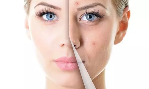 മുഖക്കുരു- കാരണങ്ങളും പരിഹാരമാര്‍ഗങ്ങളും