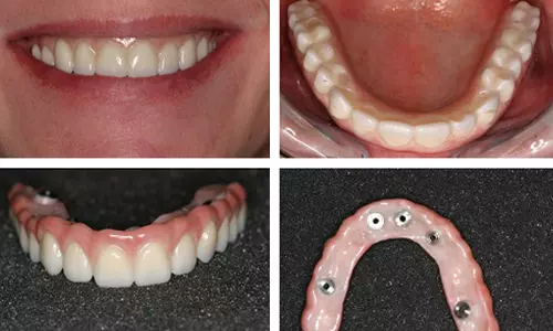 കൃത്രിമ പല്ല് വയ്ക്കാന്‍ പോവാണോ? എങ്കില്‍ ഇതൊക്കെ അറിഞ്ഞോളൂ..