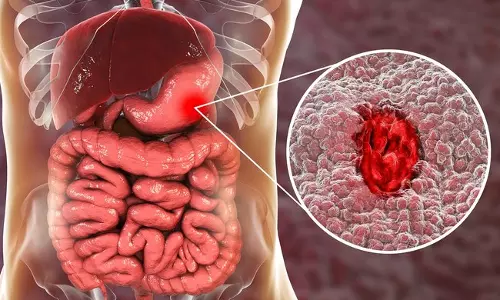 അള്‍സറിനെ അറിയാം തടയാം 
