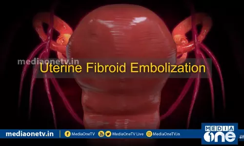 Uterine Fibroid Embolization |Stethoscope Uterine Fibroid Embolization |Stethoscope