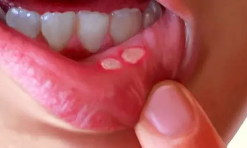 നിങ്ങള്‍ കരുതുന്നതുപോലെ ഒരു ചെറിയ അസുഖമല്ല വായ് പുണ്ണ്!