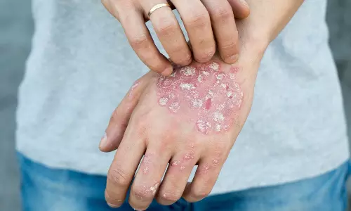 സോറിയാസിസ് ഒരു പകർച്ച വ്യാധിയല്ല; ചികിത്സിച്ച് വരുതിയിലാക്കാം
