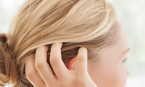 താരന്‍ അത്ര വലിയ വില്ലനാണോ ? താരനെ എങ്ങനെ ഒഴിവാക്കാം...