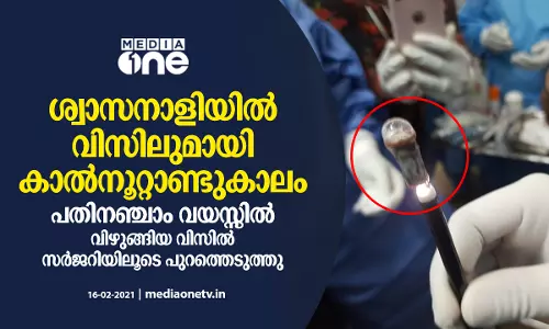 ശ്വാസനാളിയിൽ കുടുങ്ങിയ വിസിലുമായി കഴിഞ്ഞത് കാല്‍നൂറ്റാണ്ടുകാലം