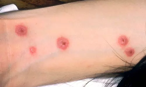 സ്റ്റീവൻസ് ജോൺസൻ സിൻഡ്രോം: കാരണവും ചികിത്സയും