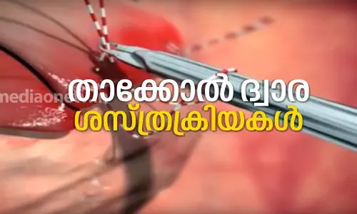 താക്കോല് ദ്വാര ശസ്ത്രക്രിയകള് താക്കോല് ദ്വാര ശസ്ത്രക്രിയകള്