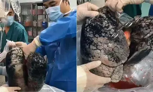 30 വര്‍ഷം പുകവലിച്ചാല്‍, ദാ ഇങ്ങനെയിരിക്കും ശ്വാസകോശം...