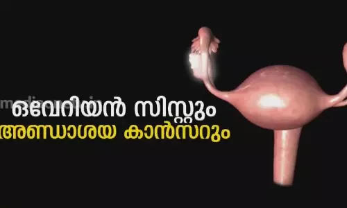 ഒവേറിയൻ സിസ്റ്റും അണ്ഡാശയ ക്യാൻസറും ഒവേറിയൻ സിസ്റ്റും അണ്ഡാശയ ക്യാൻസറും