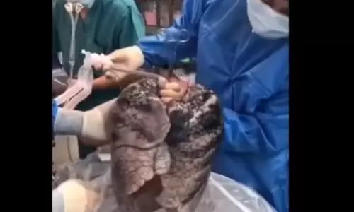 ‘’ശ്വാസകോശം സ്പോഞ്ചു പോലെയാണ്’’ പറയുന്നത് വെറുതെയല്ല; 30 വര്‍ഷത്തോളം പുകവലിച്ചയാളുടെ ശ്വാസകോശത്തിന്‍റെ ദൃശ്യം പുറത്ത്