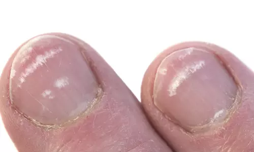 നഖം നോക്കി അസുഖം അറിയാം