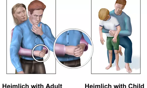 ഭക്ഷണം തൊണ്ടയില്‍ കുടുങ്ങിയാല്‍