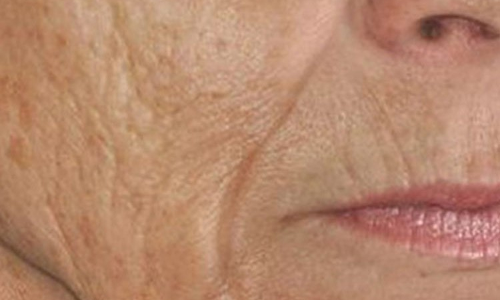 വയോധികരിലെ ചര്‍മ്മ സംരക്ഷണം