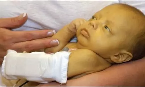 കുഞ്ഞുങ്ങളിലെ മഞ്ഞപിത്തം അറിയേണ്ടതെല്ലാം