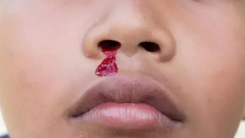 മൂക്കില്‍ നിന്നും രക്തം വരുന്നതെന്തുകൊണ്ട്? 
