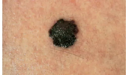 ചില മറുകുകള്‍ ശ്രദ്ധിക്കണം