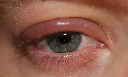 എന്താണ് കണ്ണിലെ കുരു? കാരണങ്ങളും ചികിത്സയും