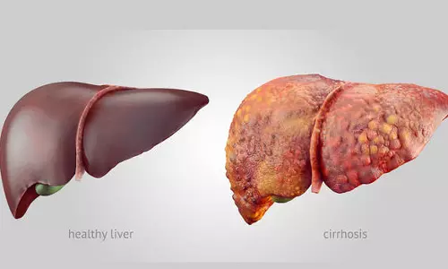 കരള്‍വീക്കം, കാരണങ്ങളും ലക്ഷണങ്ങളും