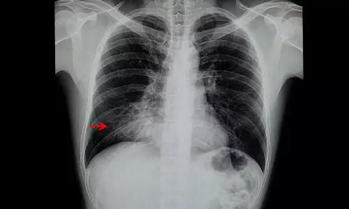 കുഞ്ഞുങ്ങളിലെ ന്യൂമോണിയ