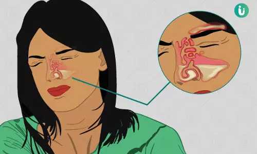 സൈനസൈറ്റിസ് അറിയാം, ചികിത്സിക്കാം...