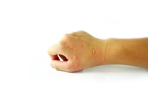 ഭക്ഷണത്തില്‍ നിന്നുള്ള അലര്‍ജി സൂക്ഷിക്കണം