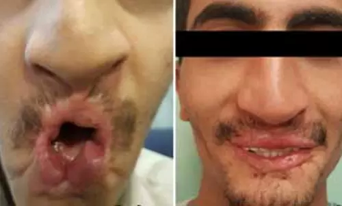 മൊബൈല്‍ വായിലിരുന്ന് പൊട്ടിത്തെറിച്ചു, യമന്‍ സ്വദേശിക്ക് ഡല്‍ഹിയില്‍ ശസ്ത്രക്രിയ