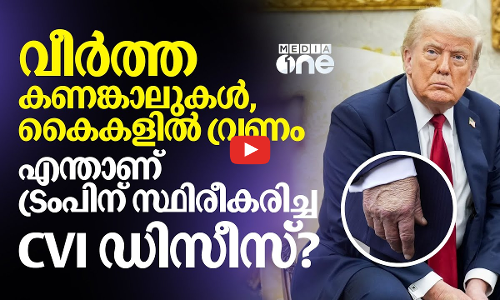 ട്രംപിന് സ്ഥിരീകരിച്ച രോഗം എന്താണ്? അറിയാം CVIയെ പറ്റി | Donald Trump | CVI