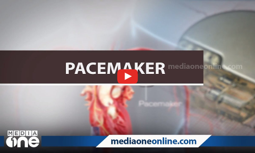 പേസ്മേക്കര്‍ ഒരു ശാശ്വത പരിഹാരമോ?