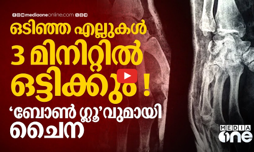 പശ വെച്ച് എല്ലുകൾ ഒട്ടിക്കാൻ ചൈന, 3 മിനിറ്റിൽ സംഗതി സെറ്റ് എന്ന് അവകാശവാദം | Bone Glue | China